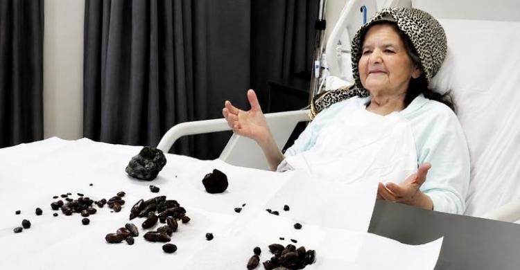 Hobi Telan Biji Dan Batu Nenek Turki Dioperasi